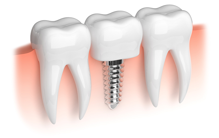 インプラントを長く保つために歯周病の予防・治療を行う理由